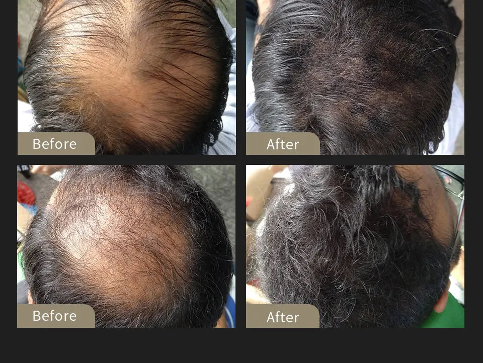SEVICH Hair Building Fiber Set — Instant Volume & Coverage for Thinning Hair