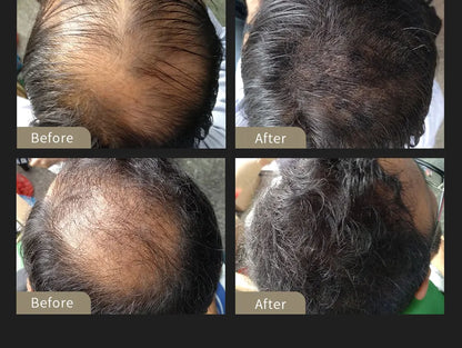 SEVICH Hair Building Fiber Set — Instant Volume & Coverage for Thinning Hair